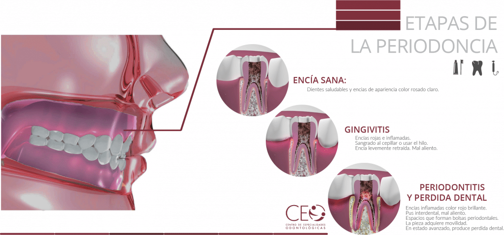 Etapas de periodoncia